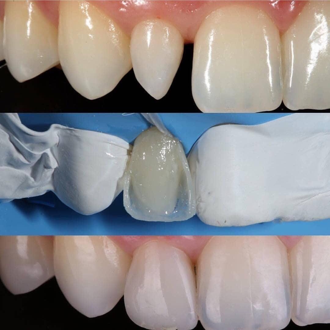 Dental Fillings
