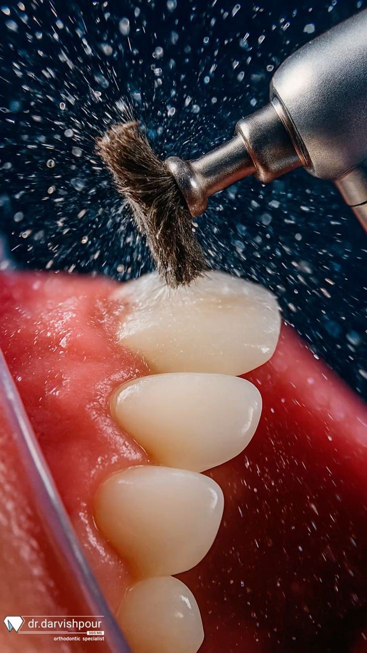 Scaling and Polishing