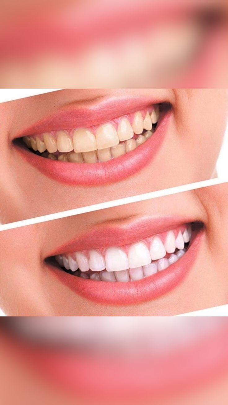 Teeth Whitening
